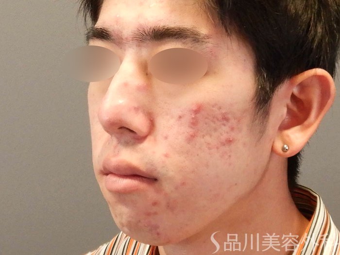 症例NO.67922のBEFORE写真
