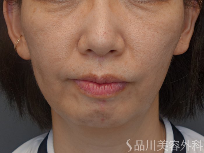 症例NO.74145のBEFORE写真