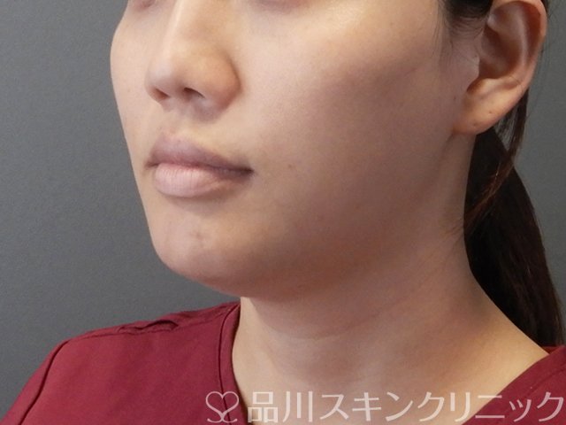 症例NO.65894のBEFORE写真