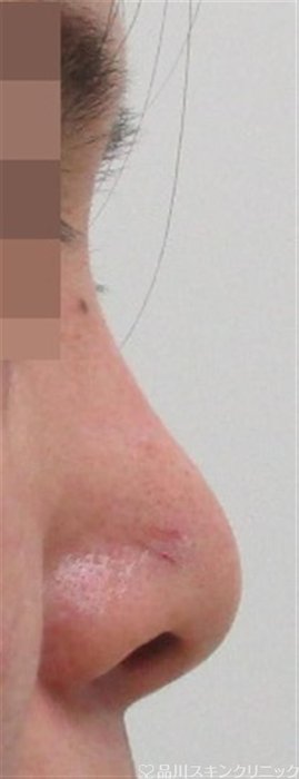 症例NO.34505のAFTER写真