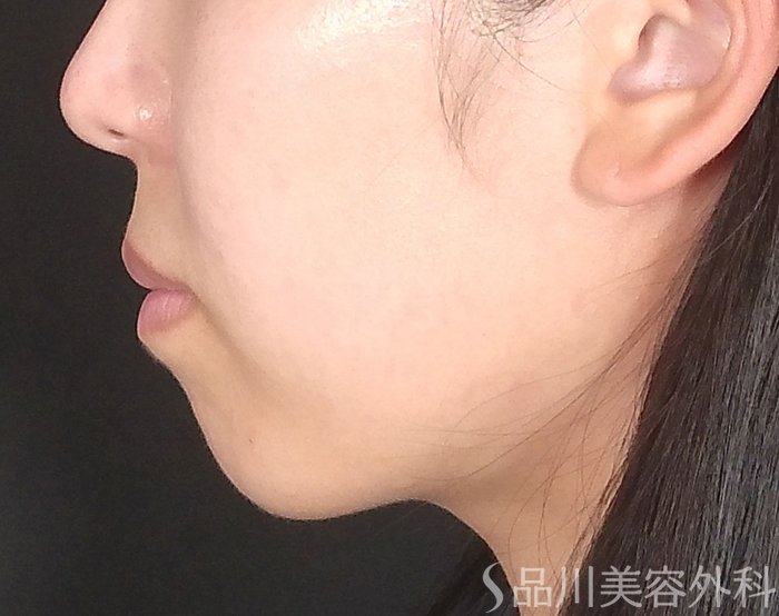 症例NO.64879のBEFORE写真