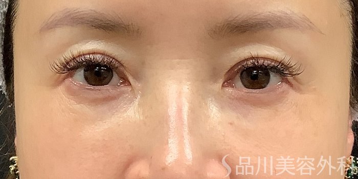 症例NO.71232のAFTER写真