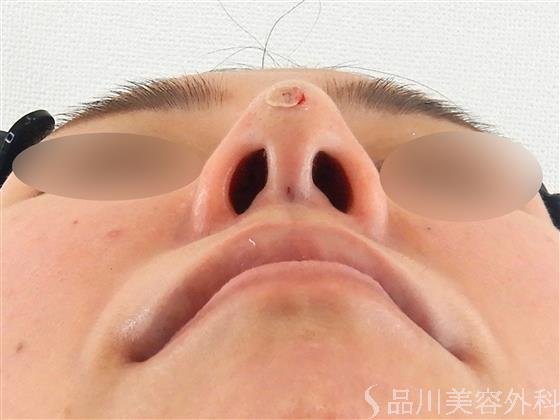 症例NO.56748のAFTER写真