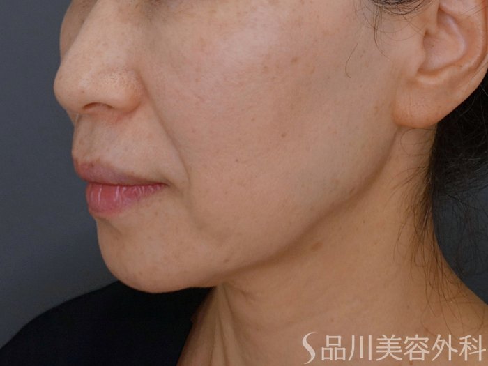 症例NO.74502のBEFORE写真