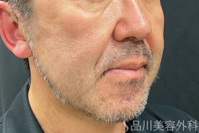 症例NO.71246のAFTER写真