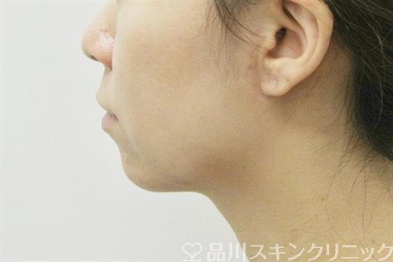 症例NO.36760のBEFORE写真