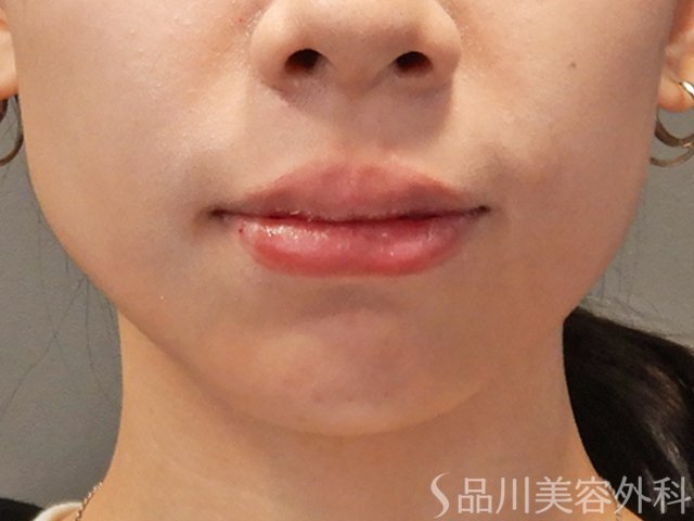 症例NO.72718のAFTER写真