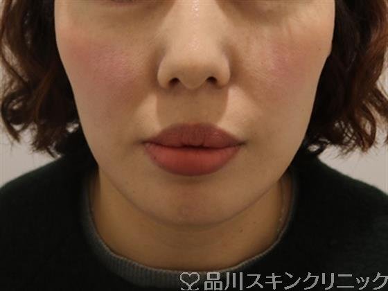 症例NO.44242のAFTER写真