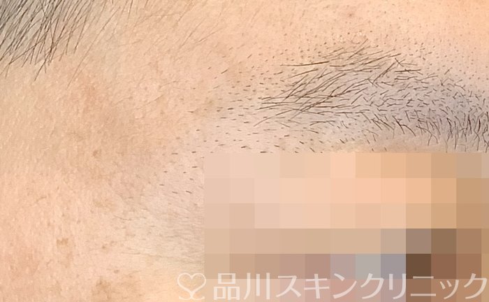 症例NO.64717のAFTER写真