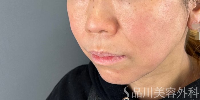 症例NO.72561のBEFORE写真