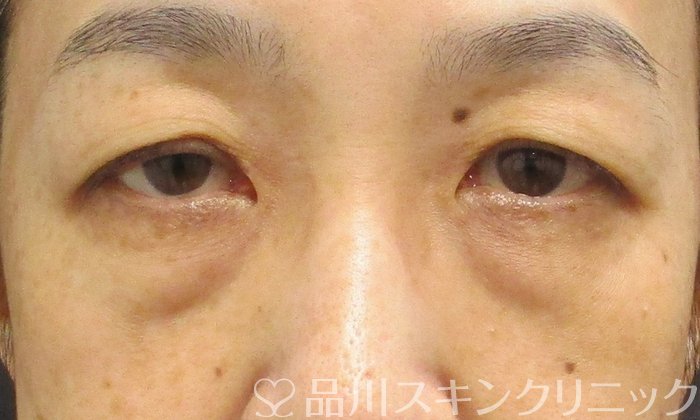 症例NO.71626のBEFORE写真