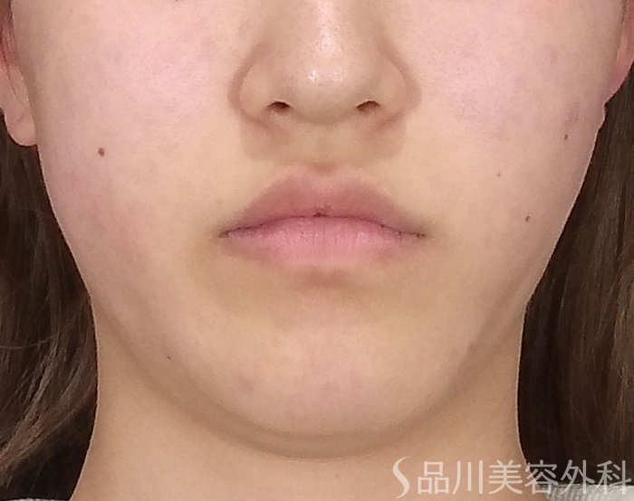 症例NO.70222のAFTER写真