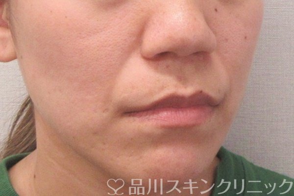 症例NO.70203のBEFORE写真