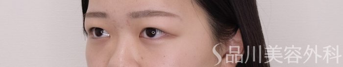 症例NO.69372のBEFORE写真