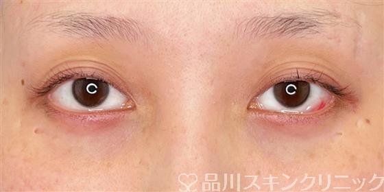 症例NO.55331のAFTER写真
