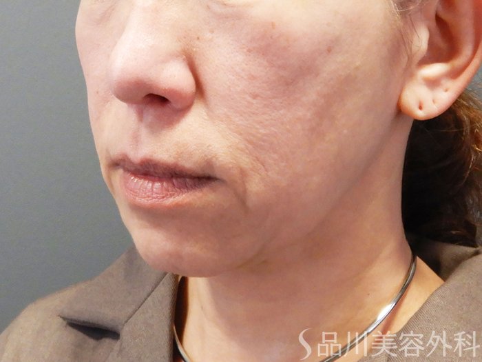 症例NO.74311のBEFORE写真