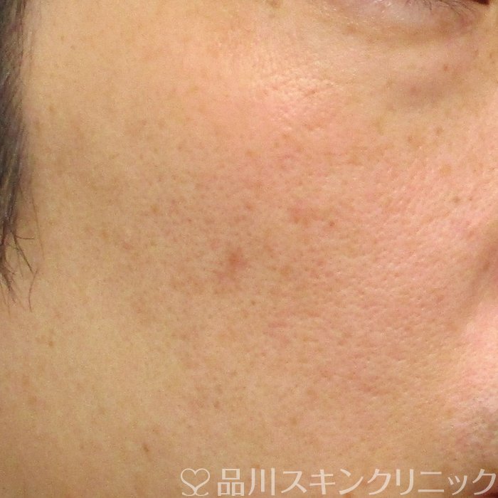 症例NO.74225のBEFORE写真