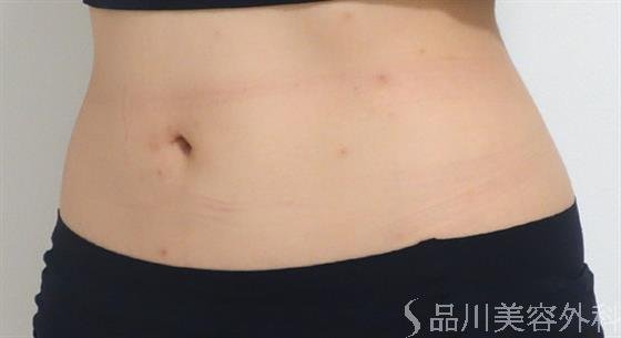 症例NO.46426のAFTER写真