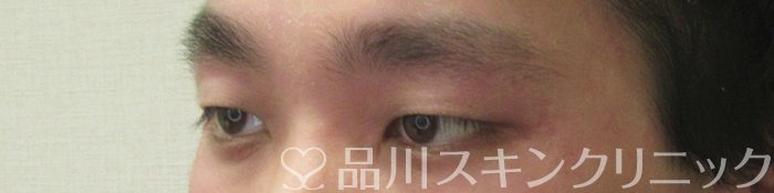 症例NO.74413のBEFORE写真