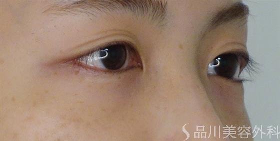 症例NO.53161のBEFORE写真