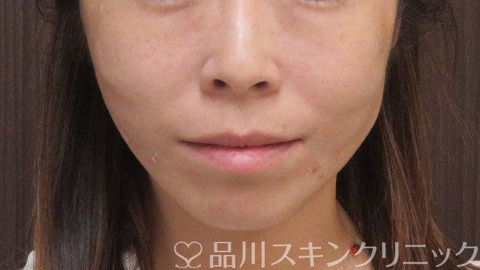 症例NO.72170のAFTER写真