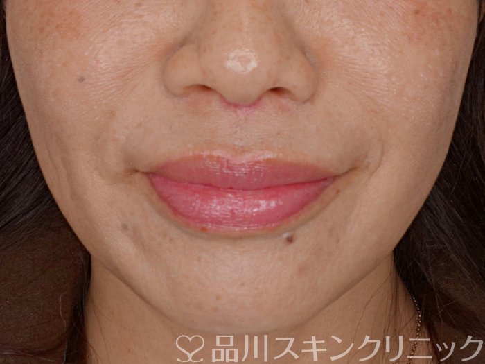 症例NO.73658のBEFORE写真