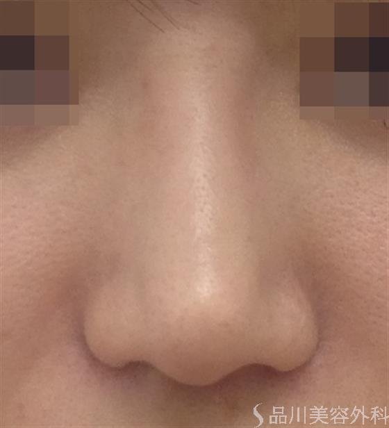 症例NO.43592のAFTER写真