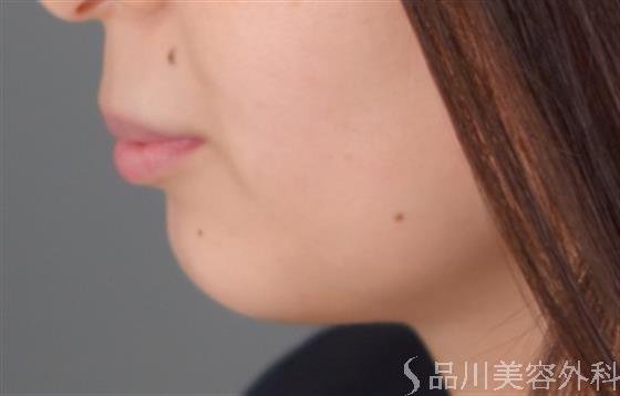 症例NO.52331のBEFORE写真