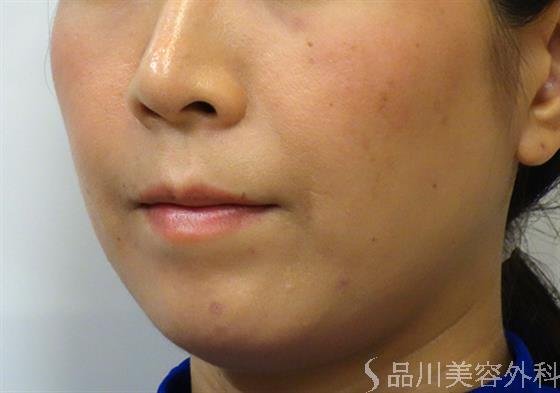 症例NO.37369のBEFORE写真