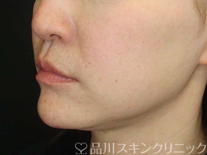 症例NO.72630のAFTER写真