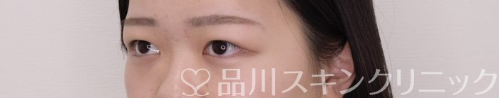 症例NO.69372のBEFORE写真