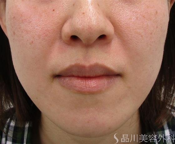 症例NO.42976のBEFORE写真