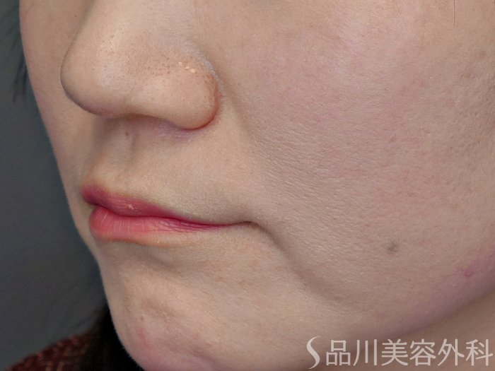 症例NO.72504のBEFORE写真