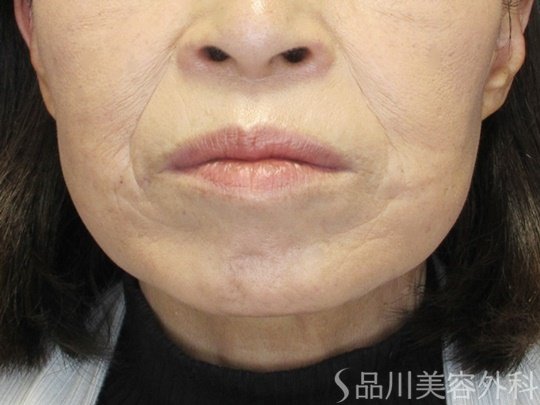 症例NO.70310のBEFORE写真