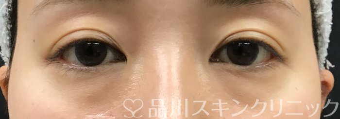 症例NO.69447のBEFORE写真
