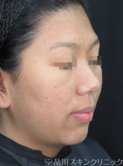 症例NO.71867のBEFORE写真