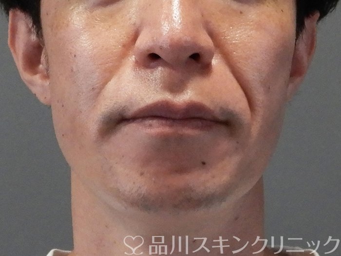 症例NO.70689のBEFORE写真