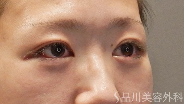 症例NO.73798のAFTER写真