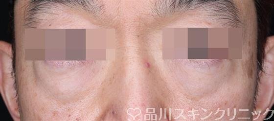 症例NO.54436のBEFORE写真