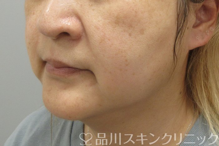 症例NO.70581のBEFORE写真
