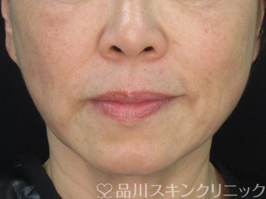 症例NO.75220のAFTER写真