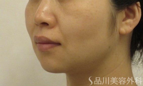 症例NO.74074のBEFORE写真