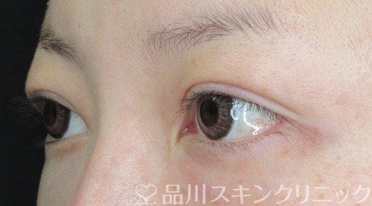 症例NO.68366のAFTER写真