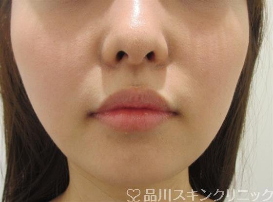 症例NO.33126のAFTER写真