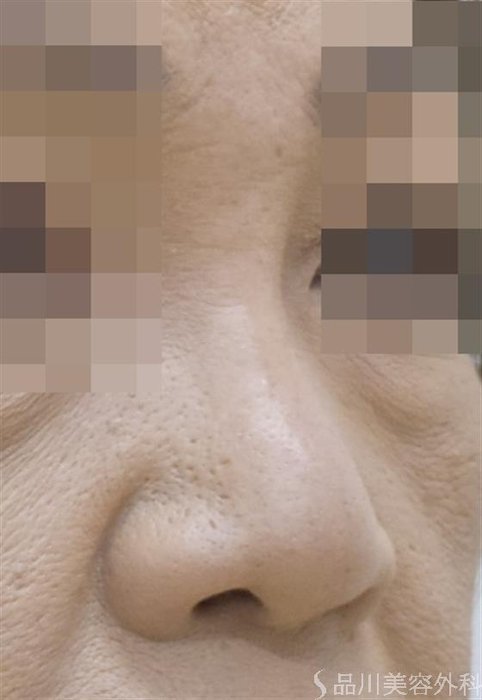 症例NO.51563のBEFORE写真