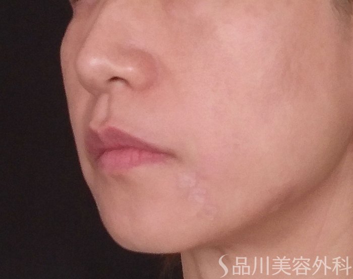 症例NO.72848のAFTER写真