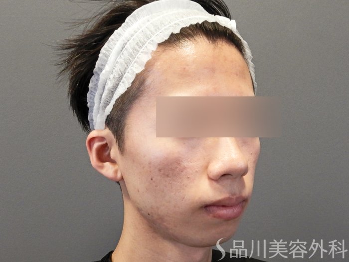 症例NO.65027のBEFORE写真
