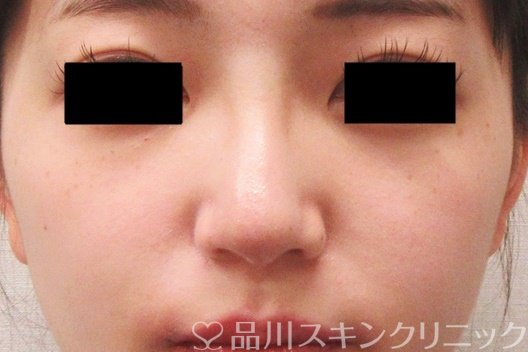 症例NO.69564のAFTER写真