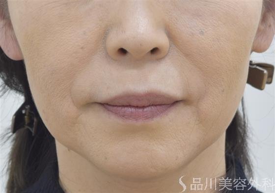 症例NO.46600のBEFORE写真