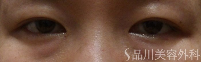 症例NO.69889のBEFORE写真